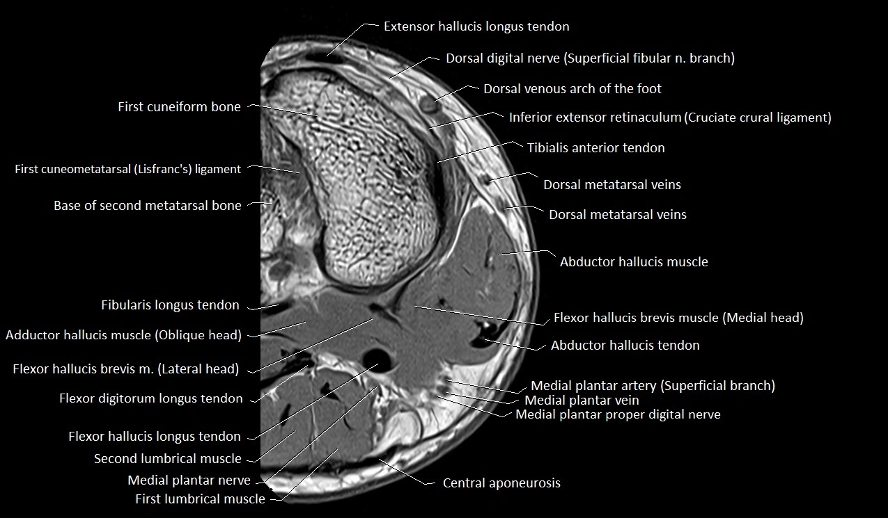Great toe (hallux) axial microanatomy 3T MRI image 47.webp